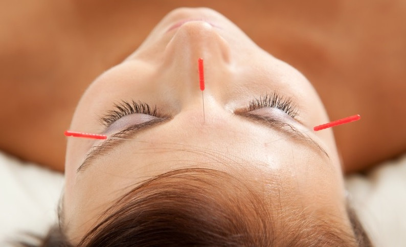 facial Cosmetic Acupuncture