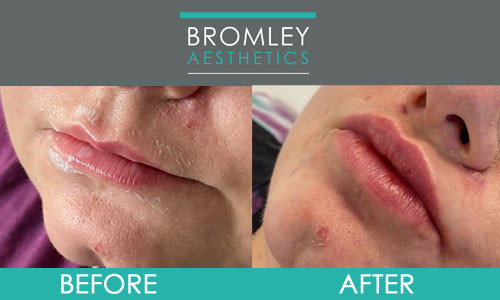 Lip Enhancement Before & After
