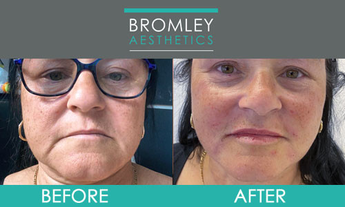 Anti wrinkle injections