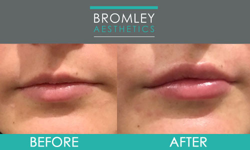 Lip Filler Bromley