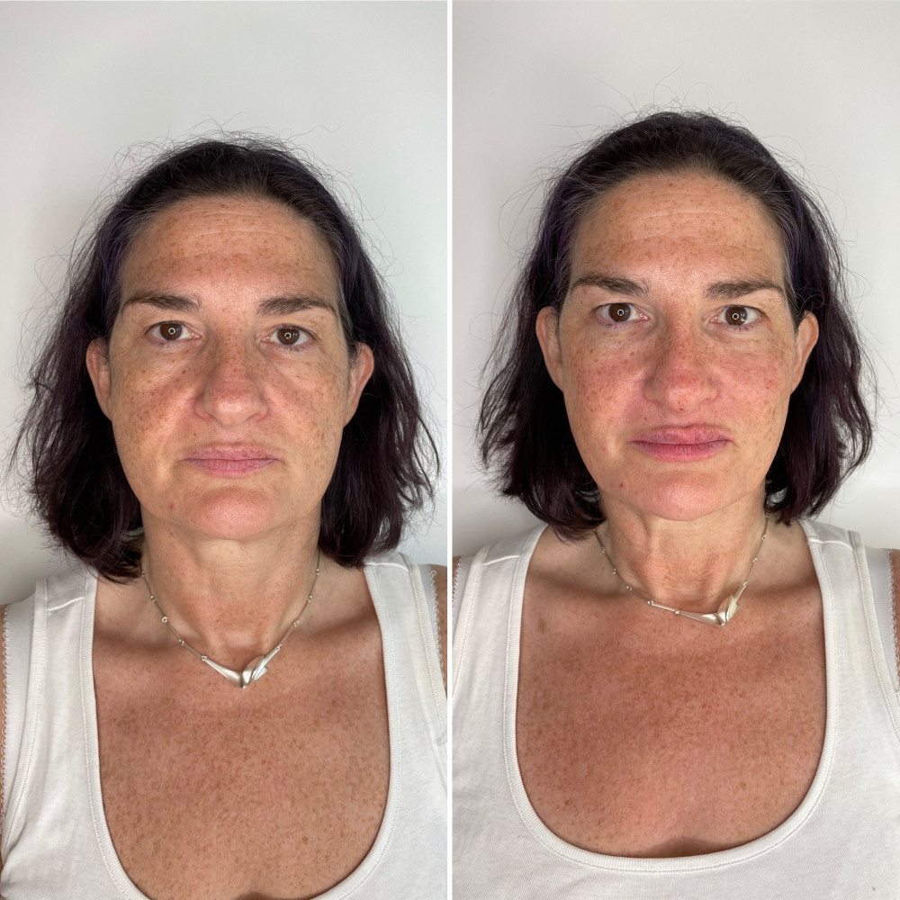 10ml Full Face Rejuvenation