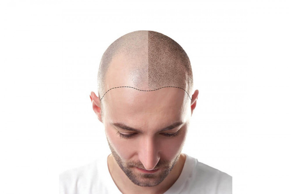 Scalp Provoco Picture