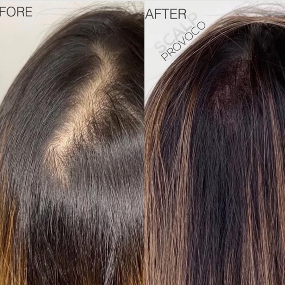 Scalp Provoco Picture