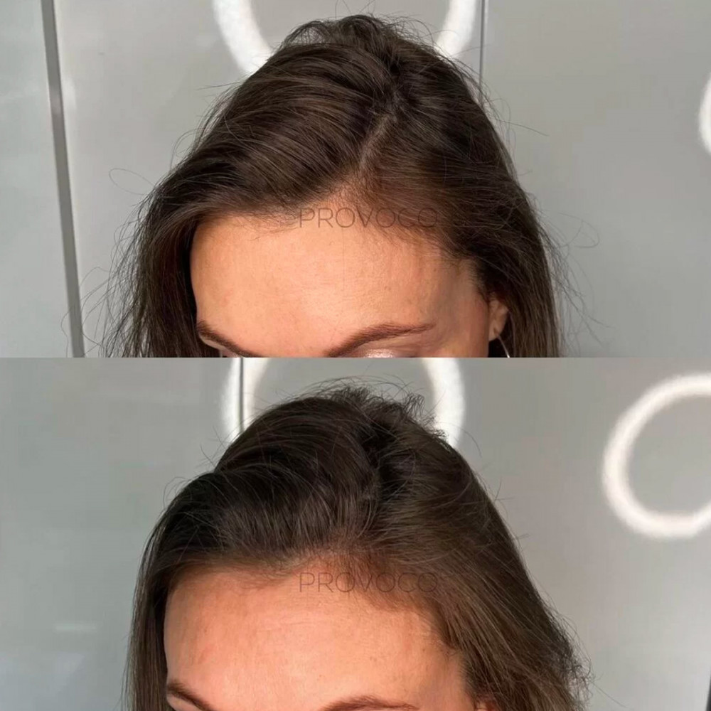 Scalp Provoco Picture