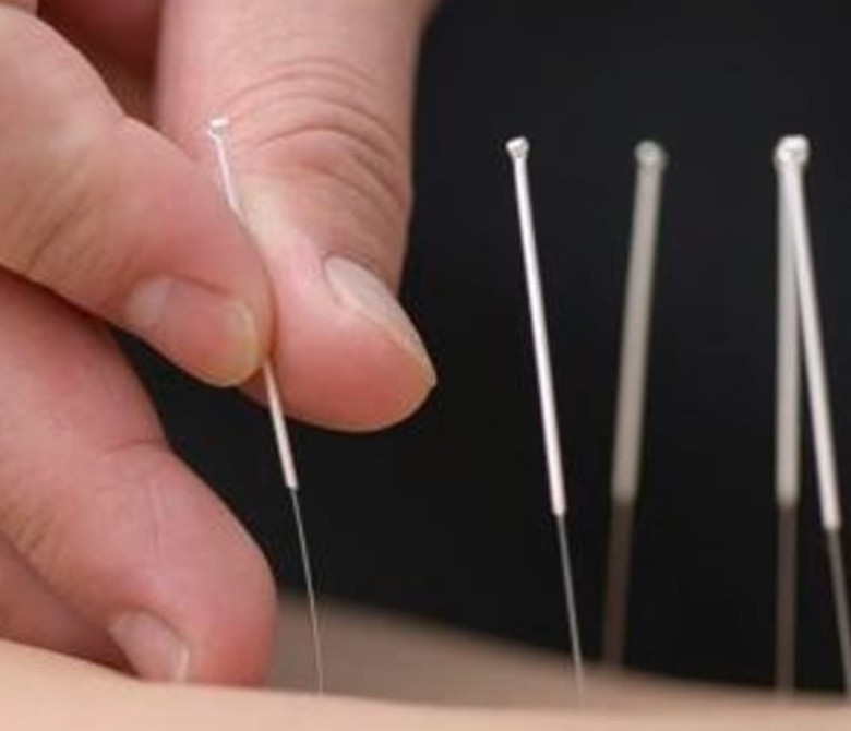 Traditional Chinese Herbal Medicine & Acupuncture Picture