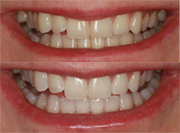 Perfect your pearly whites for National Smile Month image