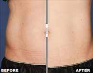 1 Treatment, 1 Hour, 1 Size Smaller... image