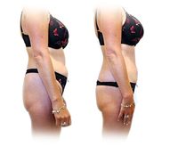 Tone Up In A Flash With Lipo Light image